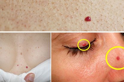 Yüzünüzdeki veya Vücuttaki Kırmızı Lekelerin Sebebi Nedir? Ne İyi Gelir? 22 vucuttaki lekeler