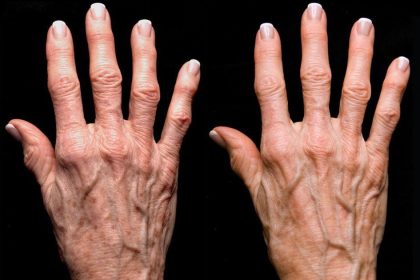 Ellerin Yaşlanmasının Sebepleri Nelerdir? 24 yasliel