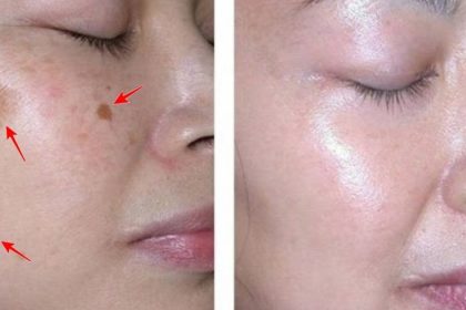 İki Malzemeli Bu Tarif Yüzünüzdeki Lekeleri 3 Gecede Geçiriyor 10 yuzdeki lekeleri giderme