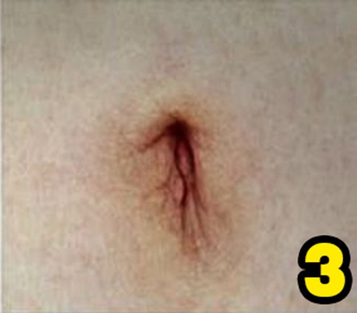 Göbek Deliğinizin Şekli Sağlığınızla İlgili Çok Şeyi Söylüyor 5 3 2