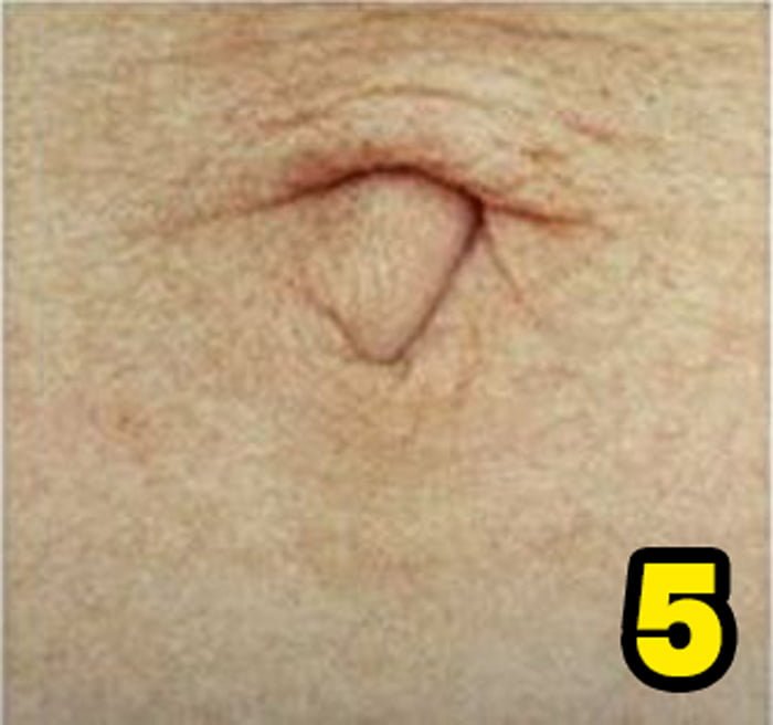 Göbek Deliğinizin Şekli Sağlığınızla İlgili Çok Şeyi Söylüyor 7 5 1