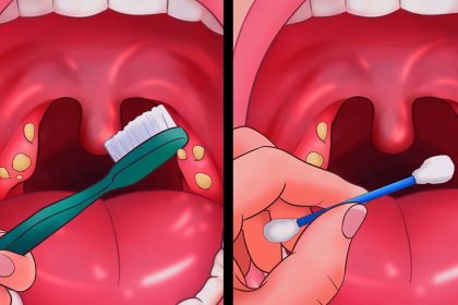 Bademcik Taşı Problemlerine Bu 6 Yöntemle Son Verin 4 bademcik tasi problemlerine bu 6 yontemle son verin