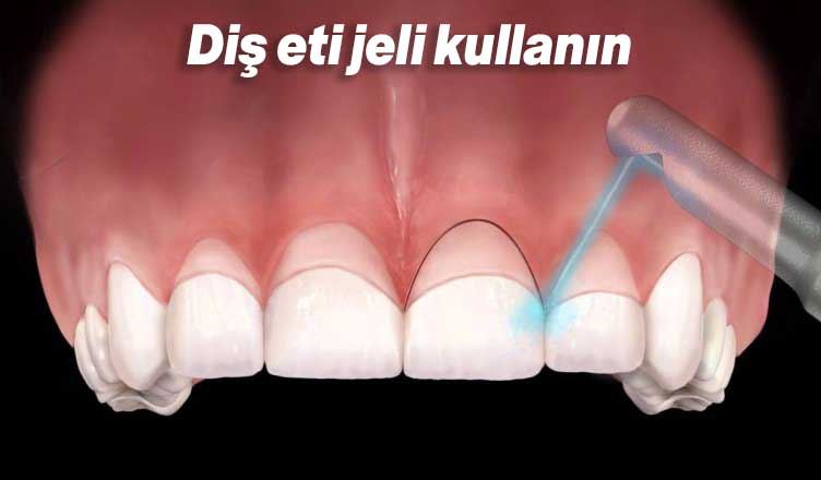 Diş Sararmasını Önlemenin En Garanti Yolları 3 diş eti jeli kullanın