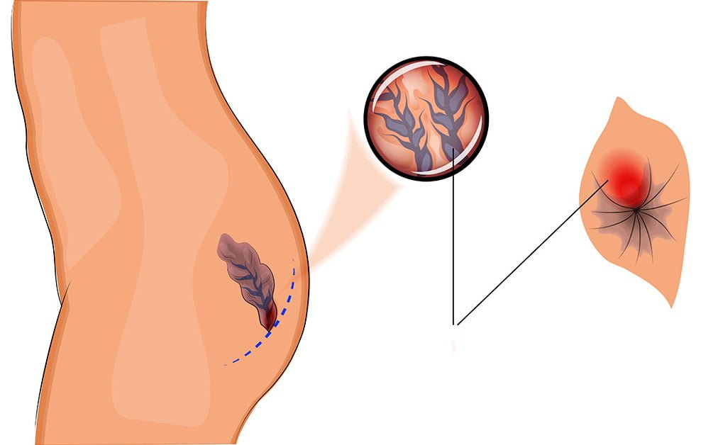 Kabız Olduğunuzda Vücudunuzda Bunlar Oluyor 5 hemoroit2