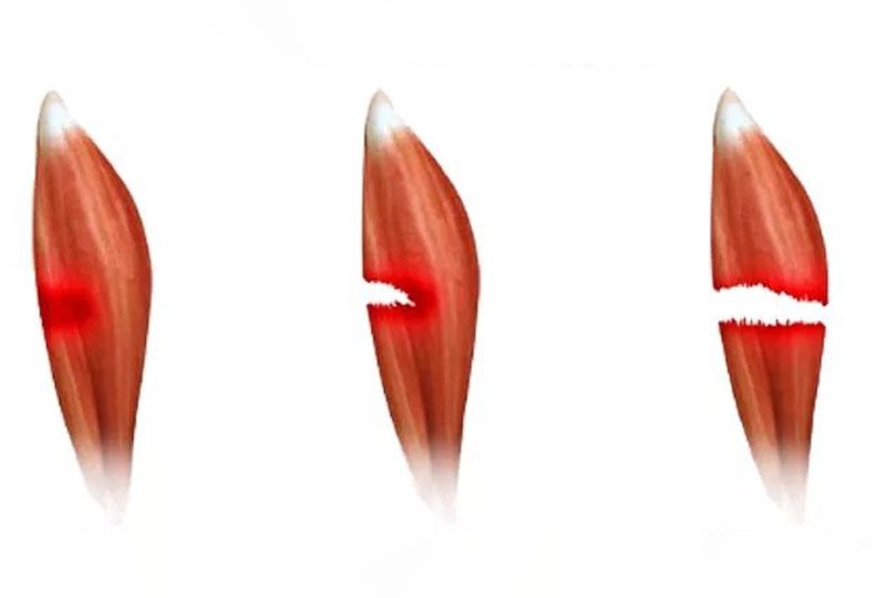 Kabız Olduğunuzda Vücudunuzda Bunlar Oluyor 2 kas yirtilmasi