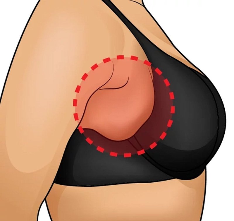 Dar Giysiler Giyince Koltuk Altı Yağlarınız Mı Ortaya Çıkıyor? İşte Çözümü 3 koltuk alti2