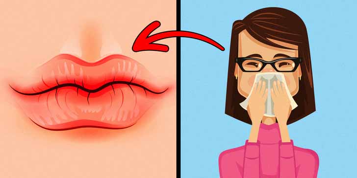 kuru ve catlak dudaklar1