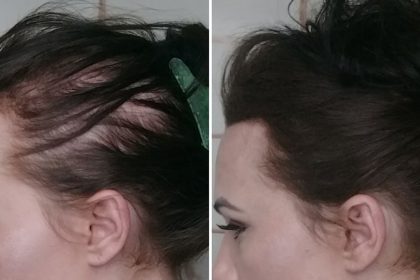 Saç Dökülmesini Hayatınızdan Komple Çıkaran Bu Tarifi Mutlaka Denemelisiniz 20 sac dokulmesi4