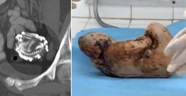 Karnındaki Bebeğini 50 Yıl Sonra Doğurdu 6 dogurmadan 50 yil