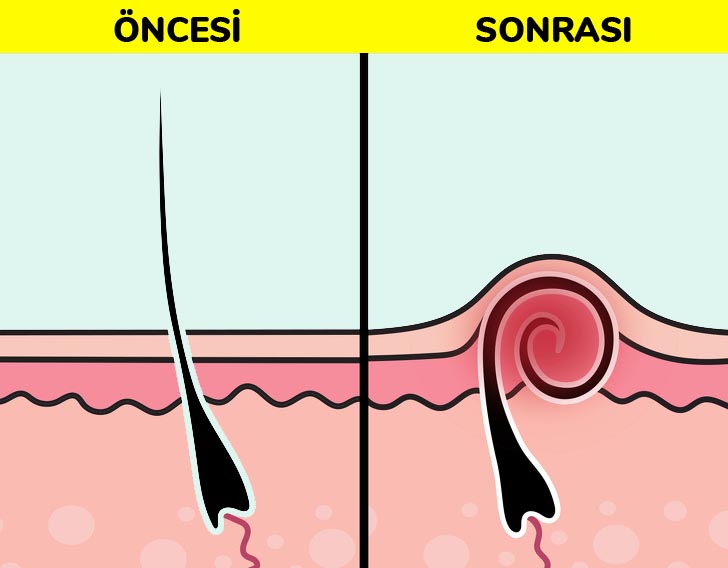 killarin cikarilmasi