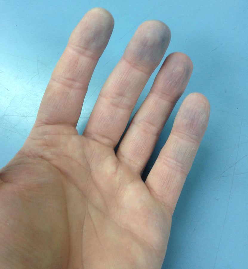 Ellerinizin Size Anlatmak İstediklerine Kulak Verin 3 parmak mavilesme