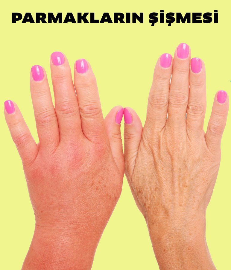 Ellerinizin Size Anlatmak İstediklerine Kulak Verin 8 parmak sismesi2