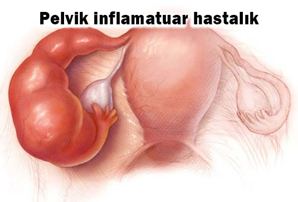 Vaj-inal Akıntı Neden Meydana Gelir? 3 pelvik inflamatuvar hastalik