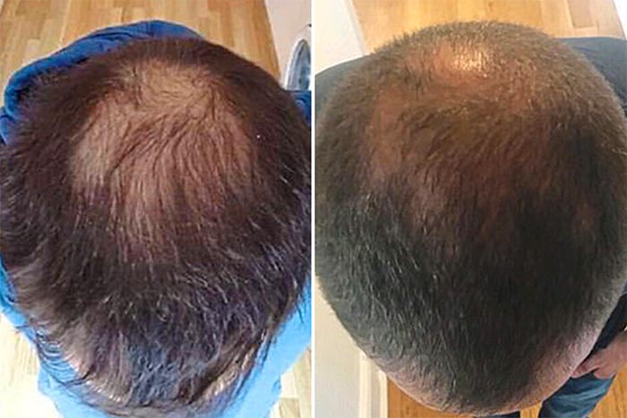 sac dokulmesi oncesi sonrasi