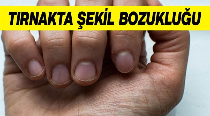 tırnakta şekil bozukluğu