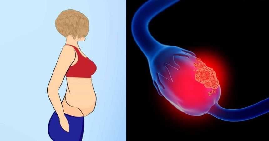 Yumurtalık Kanserine Karşı Karındaki Şişlikler 1 yumurtalik kanseri belirtileri