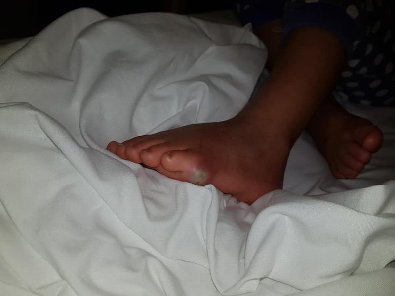 Çorapsız Ayakkabı Giyen Çocuğun Ayağı Böyle Oldu 5 ayak2