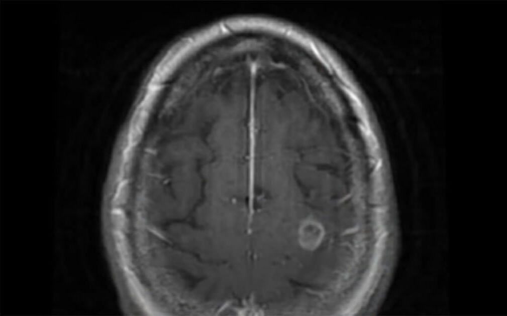 69 Yaşındaki Kadın Burnunu Yıkamak İçin Musluk Suyu Kullandı Sonrası Herkese İbret Oldu... 2 beyin