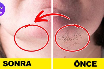 Evinizdeki Malzemelerle, Yüz Tüylerinizden Kurtulun 10 evinizdeki malzemelerle yuzunuzdeki tuylerden kurtulun