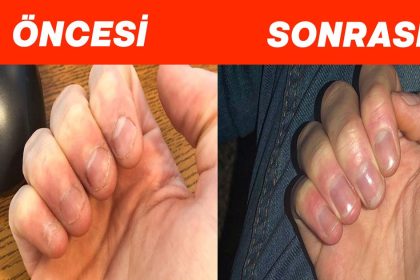 tirnak yemekten kurtulmanin yollari