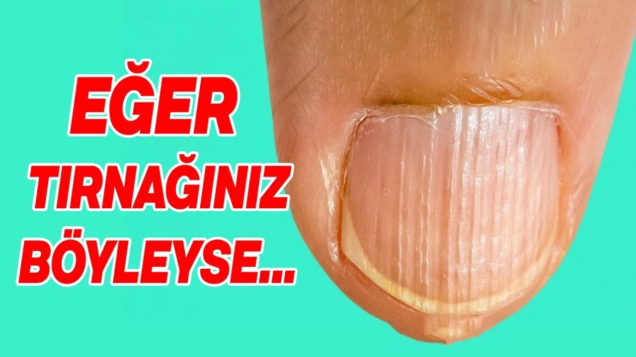EĞER TIRNAĞINIZ BÖYLEYSE ( Protein Eksikliğinin 5 Belirtisi)