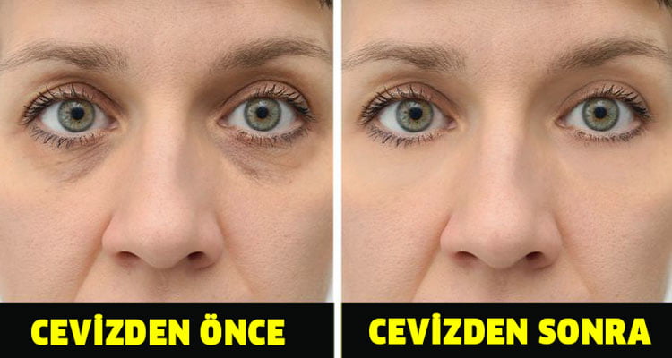 Her Gün Ceviz Yerseniz Ne Olur ? 5 goz torbalari