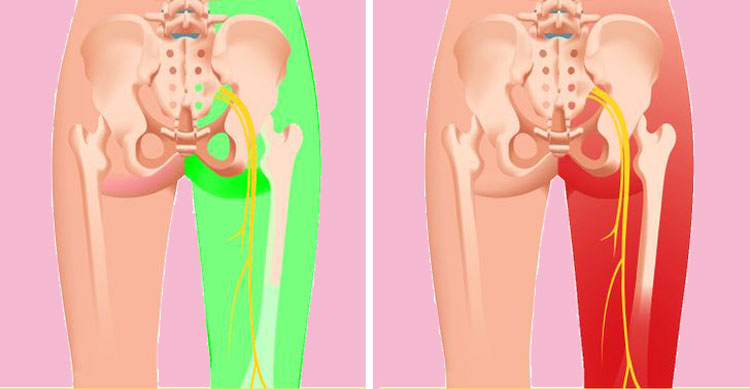 Yerde Uyumaya Başlarsanız Ne Olur? 5 siyatik