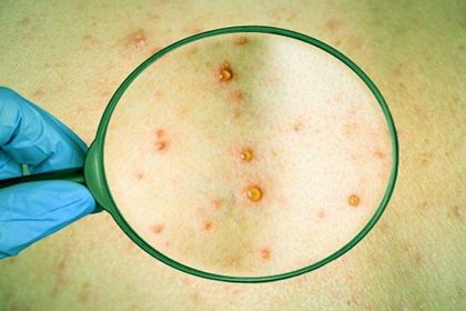 Maymun Çiçeği Virüsü Belirtileri Nelerdir Nasıl Bulaşır