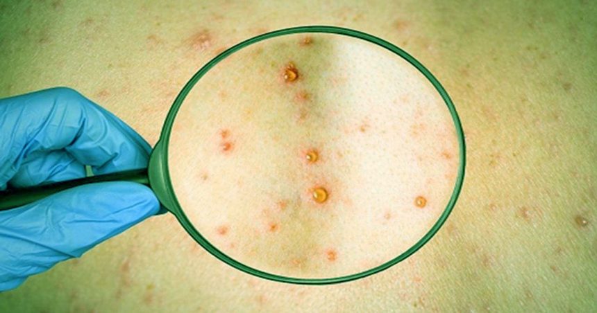 Maymun Çiçeği Virüsü Nedir? Nasıl Bulaşır? Belirtileri Nelerdir? 14 Maymun Çiçeği Virüsü Belirtileri Nelerdir Nasıl Bulaşır