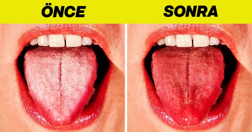 Dil Beyazlamasının Gerçek Sebebi Ve Ne Yapılmalı? 1 dil neden beyazlar